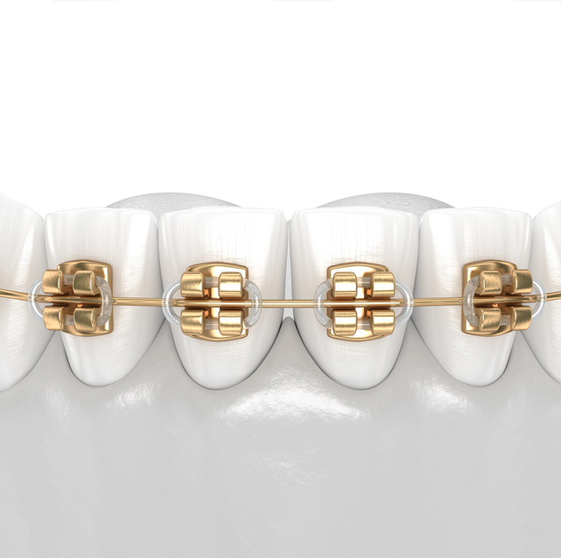 Benefits of metal braces