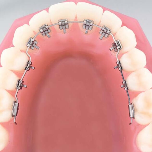 Incognito lingual braces are just like regular fixed braces