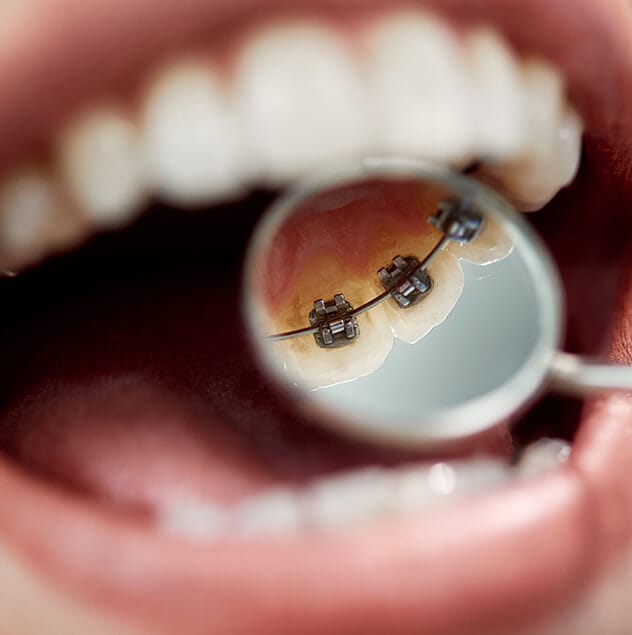 Incognito braces work for almost all orthodontic issues