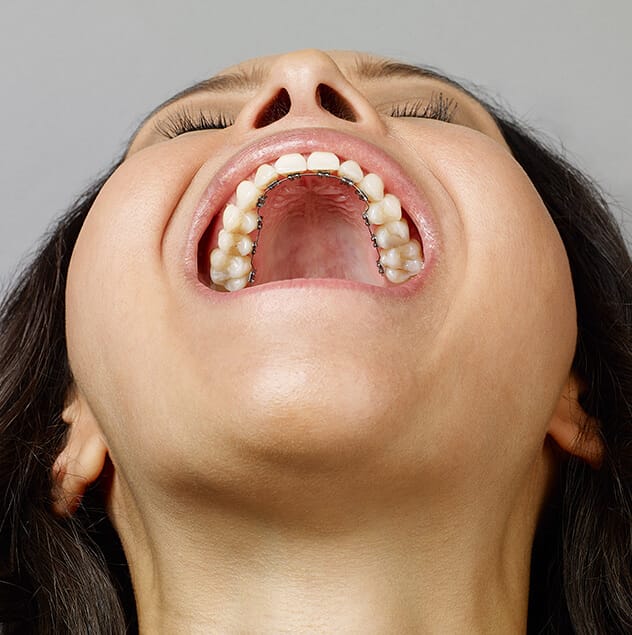 What are Incognito braces