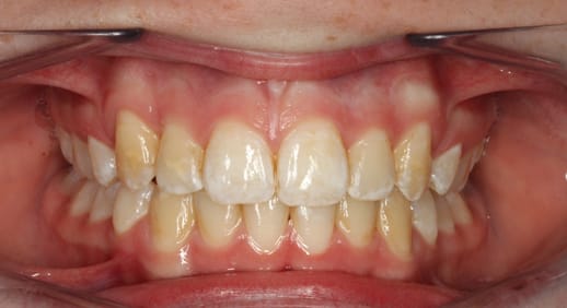 After orthodontist treatment at Confident