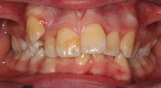 Before orthodontist treatment at Confident