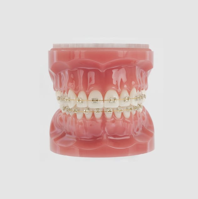 Confident Orthodontics provide ICONIX aesthetic braces