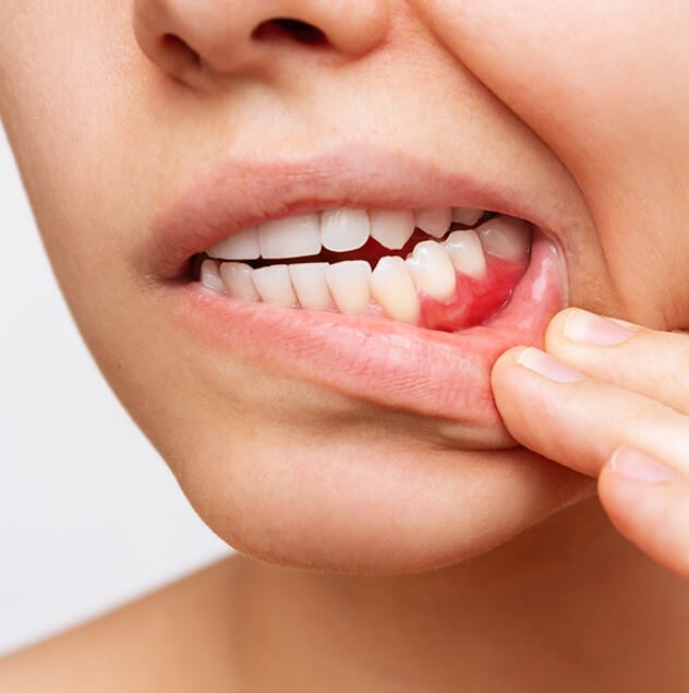Gingivitis is another name for gum inflammation