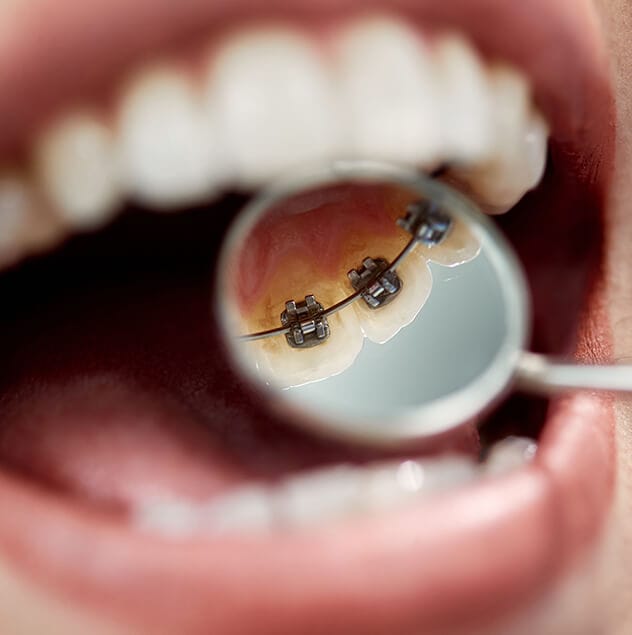 Incognito™ braces aren’t just discreet, they’re completely hidden behind your teeth