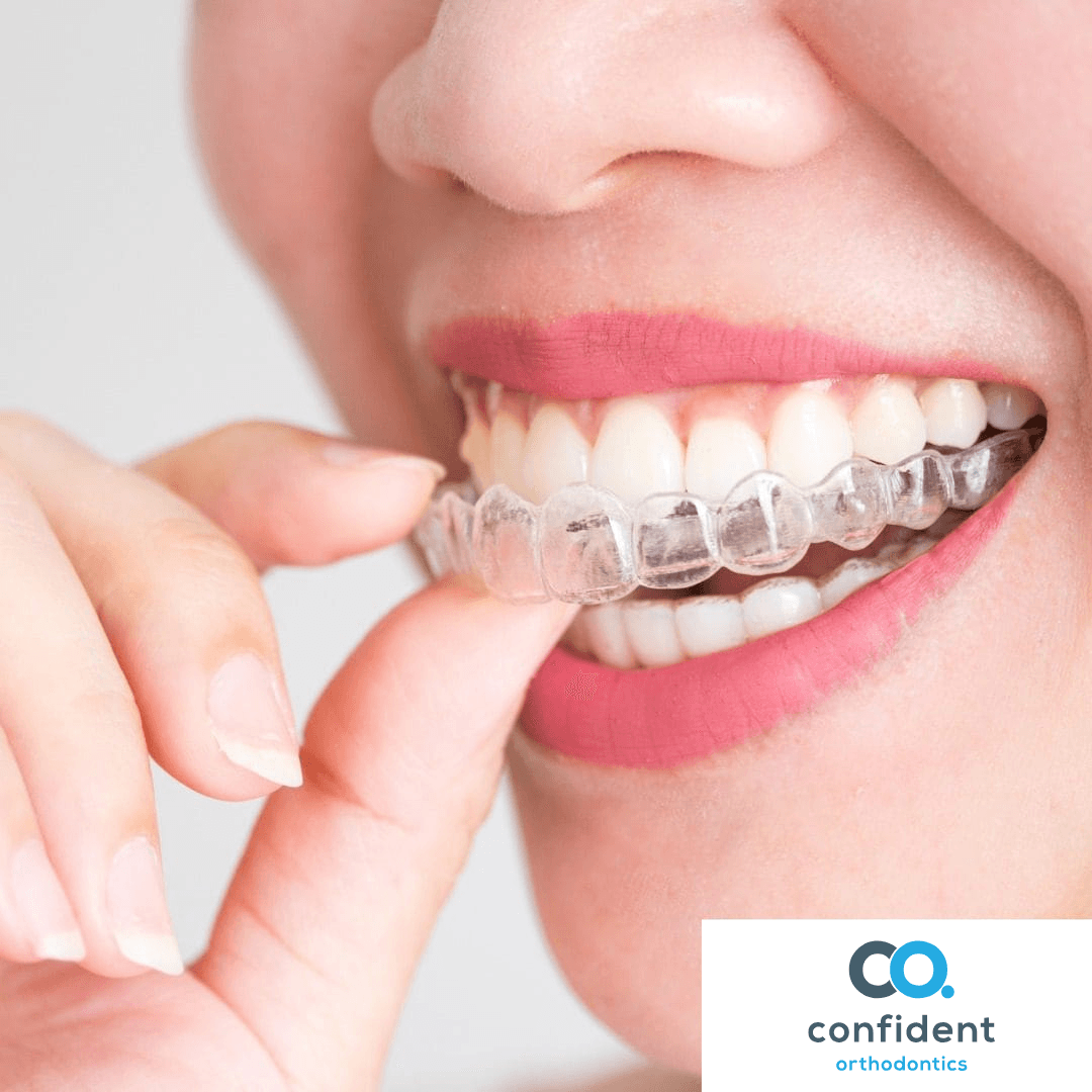 Why choose Invisalign over braces in Taunton