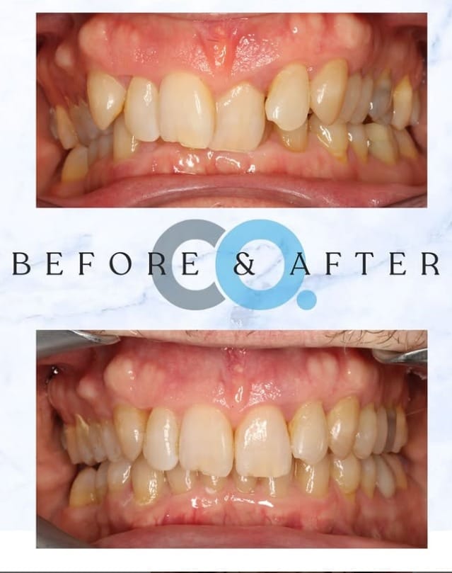 Giles received invisalign treatment from confident orthodontics taunton