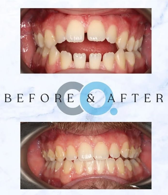 clear aligners case study for confident orthodontics