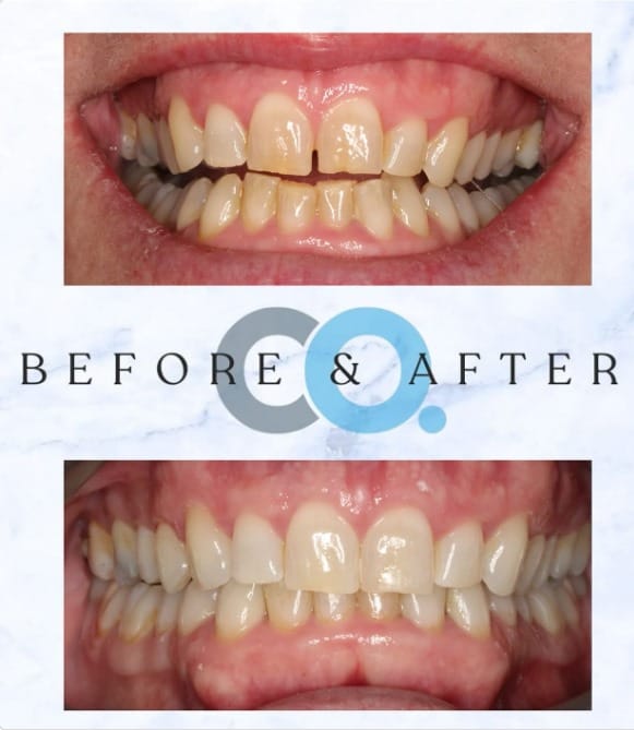 Mary receiving angel aligners from confident orthodontics in Taunton