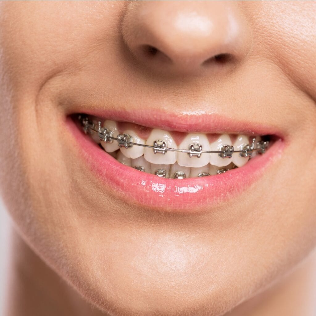 Orthodontist Somerset: How Long Do Braces Take To Work?