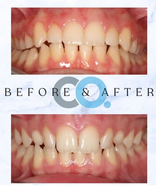Ellie received fixed appliance treatment at Confident Orthodontics