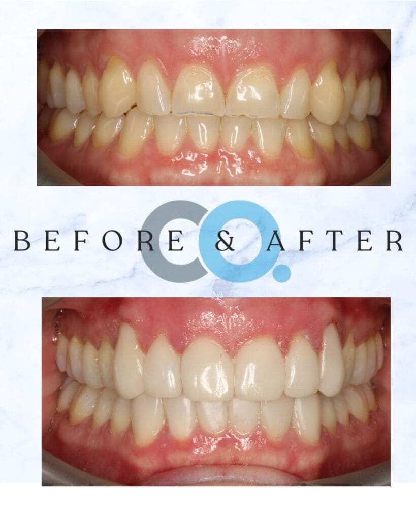 Maria received Angel Aligners from Confident Orthodontics Taunton