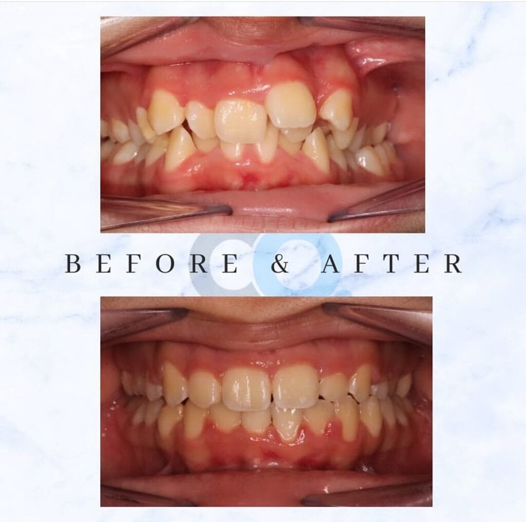 Nadia received fixed braces from Confident Orthodontics Taunton