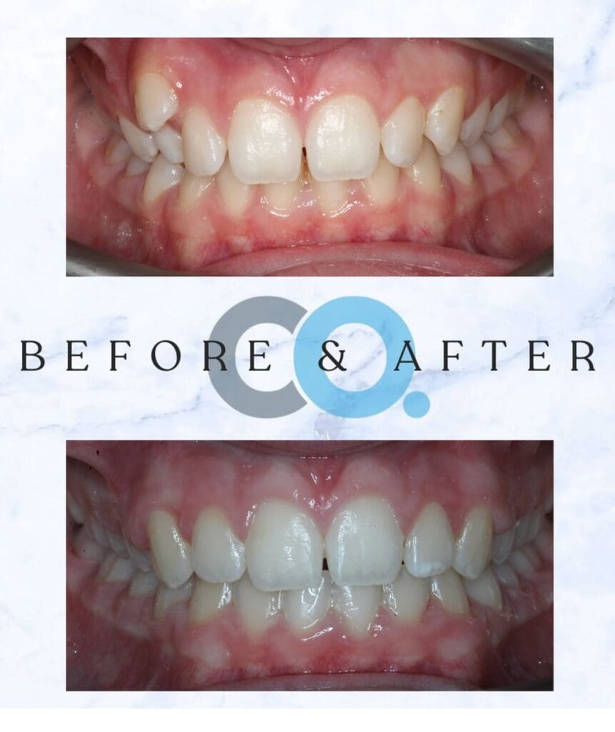 Fixed Braces Taunton meet Annabelle