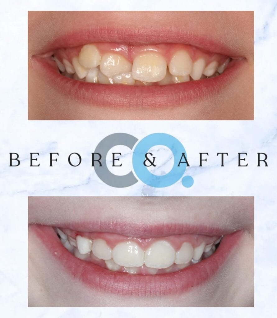 Sarah receives braces treatment in Taunton