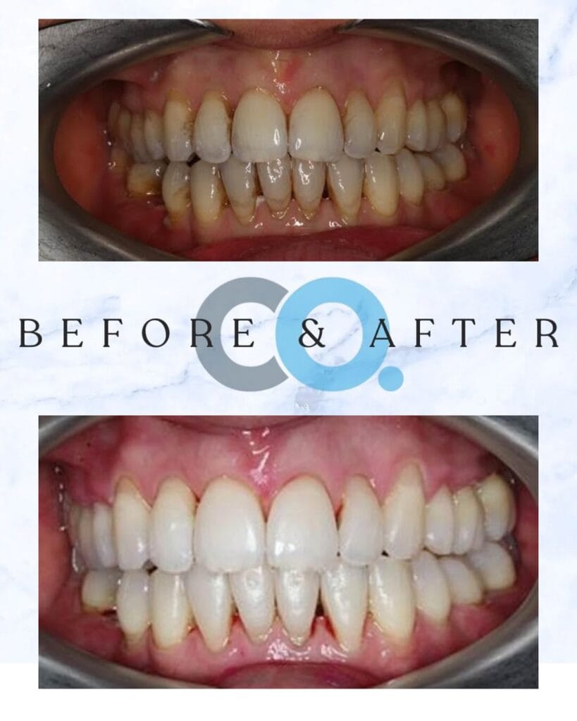 Vanessa receives orthodontic treatment in Somerset