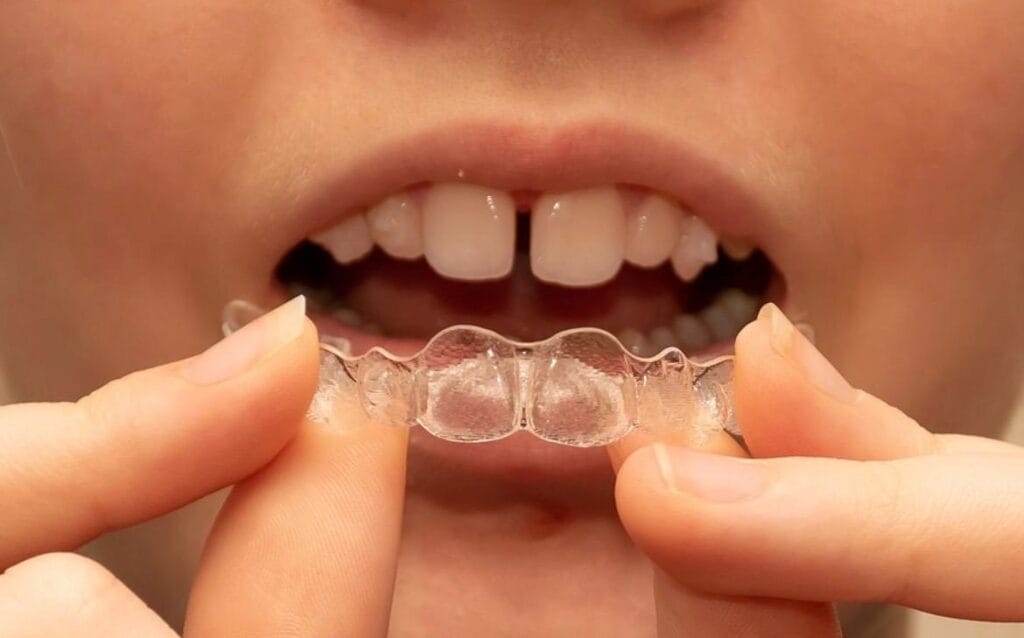 Does Invisalign Treatment Hurt? We answer your most common questions!