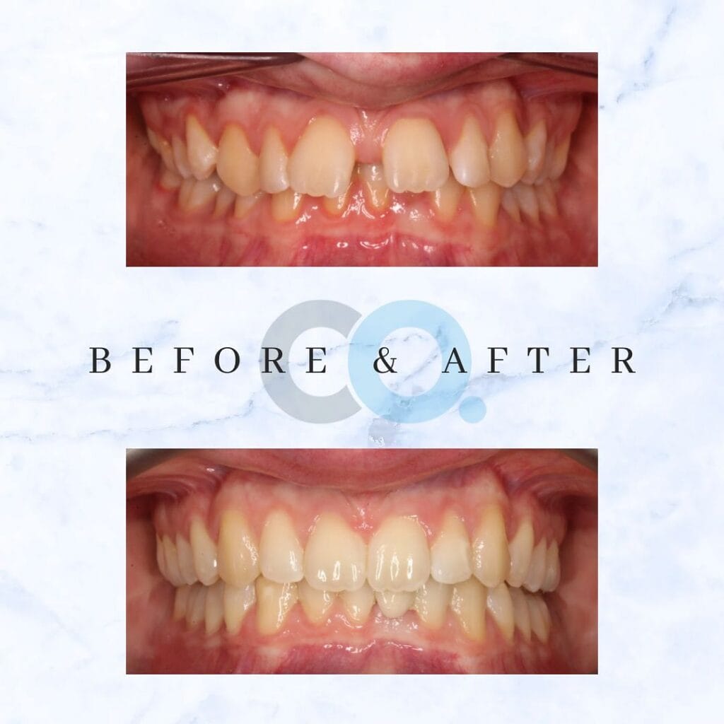 Charley receives fixed braces Taunton